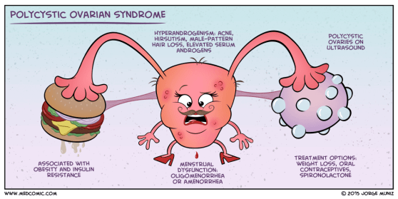 53-polycystic-ovarian-syndrome